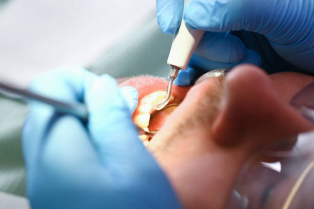 Best Emergency Root Canal Treatment in Stratford, OK