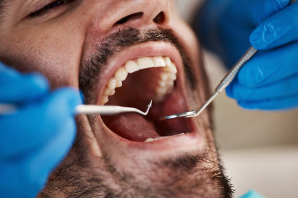 Best Emergency Wisdom Teeth Removal in Stratford, OK