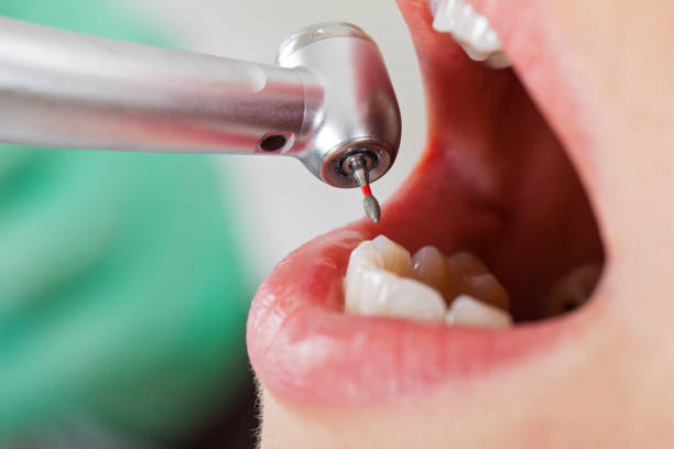 Best Emergency Wisdom Teeth Removal in Stratford, OK